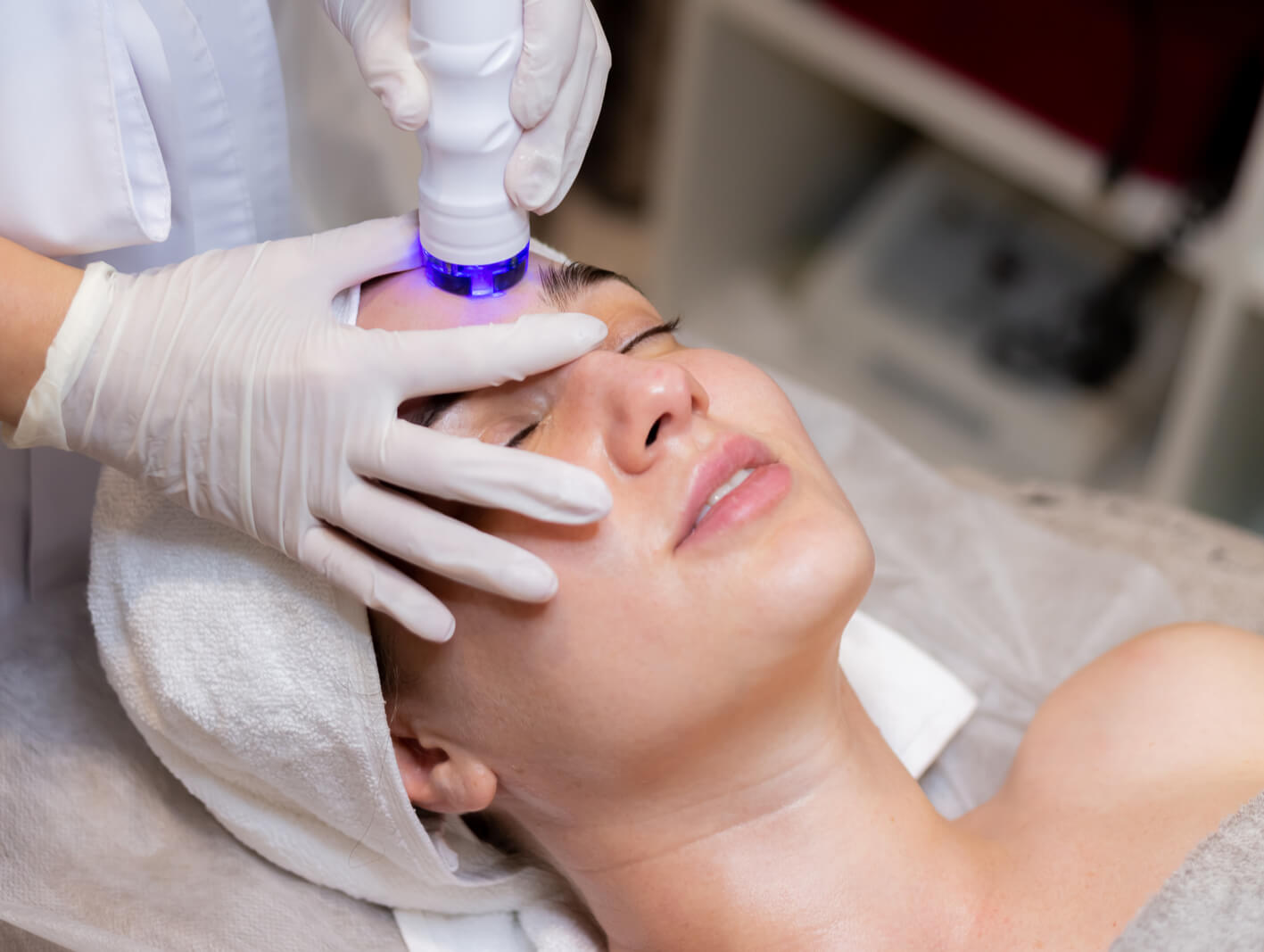 Chemical peel before after results